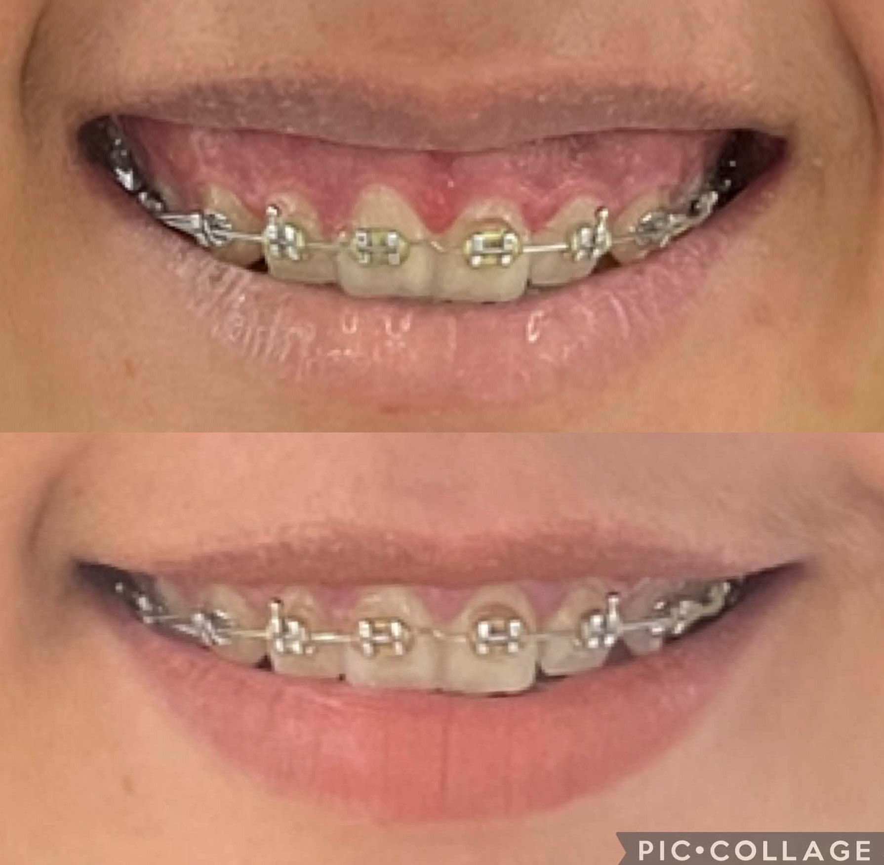 Precision Implant & Veneer Restoration
